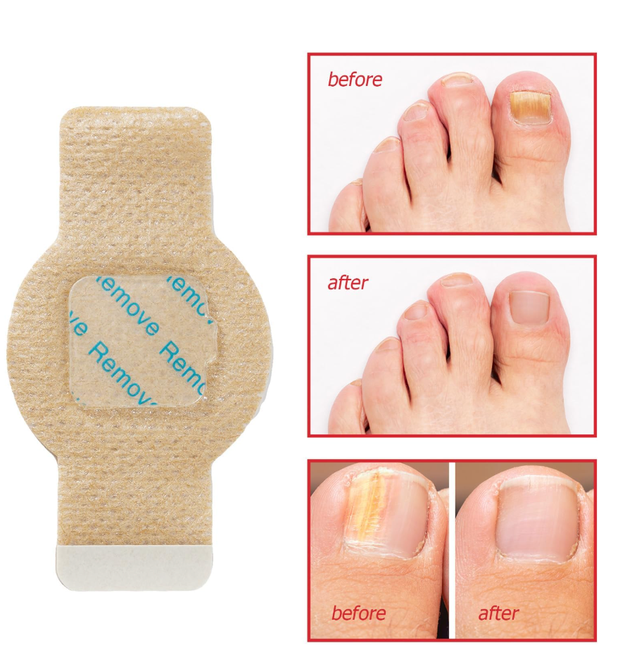 Fungus Nail Patches